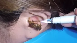 The Most Massive Earwax Removed in One Scoop