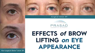 How Brow Lifting can Help with Eye Appearance, and other Procedures to Open Up the Eyes