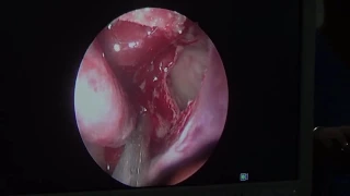 FESS Unedited ( Case 7 ) - Dr. Satish Jain - www.skullbase360.in