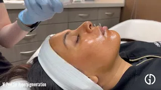 Vi Peel for Hyperpigmentation | Geria Dermatology