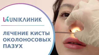 👃 Диагностика и лечение кисты околоносовых пазух носа. Киста околоносовых пазух носа. UNIКлиник. 18+