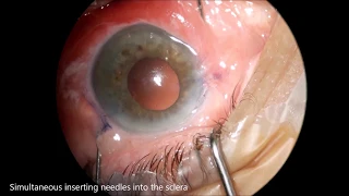 Yamane technique, IOL Scleral fixation by Dr. ADRIAN GÃVÅNESCU  eyesaid.com