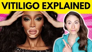 Vitiligo: WHY YOU HAVE IT & WHAT TO AVOID