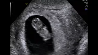 What Can You See At A 9 Week Baby Scan?