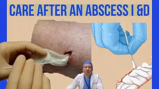 How to pack an abscess I&D site | Wound packing | After incision and drainage of an abscess