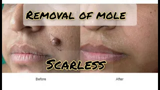 Mole Removal ( painless/ scarless)