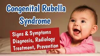 Congenital Rubella Syndrome (CRS) Symptoms, Diagnosis and Treatment | TORCH Infections