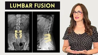 #110 Lumbar Fusion Surgery. Can you exercise?