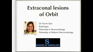 Extraconal lesions of Orbit- Simplified