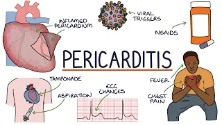 Understanding Pericarditis