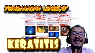 All About Keratitis (definisi, etiologi, gejala, pemeriksaan, bakterial, virus, jamur) UKMPPD Mata