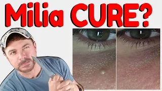 How To Get Rid Of Milia | Hard White Bumps on Face and Eyes | Chris Gibson