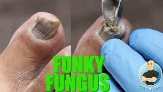 HAVE NAIL FUNGUS? YOU NEED TO BE DOING THIS!!!! ***SUPER IMPORTANT TIP***