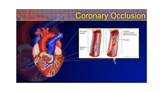 The 12-Lead ECG Course - STEMI Part 1