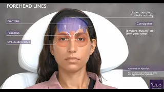 Functional Anatomy of the Upper Face & Corresponding Injection Sites with BOTOX Cosmetic