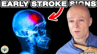 10 Warnings Signs Of STROKE A Week BEFORE It Happens