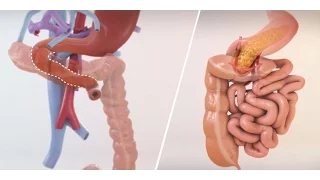 Isolated bowel transplant