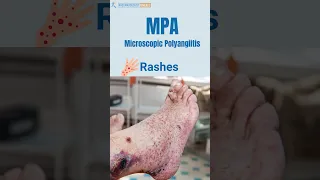 MPA Vasculitis (Microscopic Polyangiitis) Signs - You Should Not Ignore