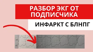 Инфаркт миокарда при БЛНПГ. Разбор ЭКГ от подписчика. ОКС с подъемом сегмента ST