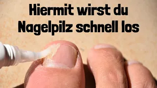 So wirst du Nagelpilz schnell los