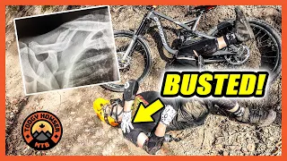 I broke my collarbone mountain biking!