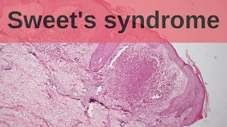 Sweet's Syndrome - Pathology mini tutorial