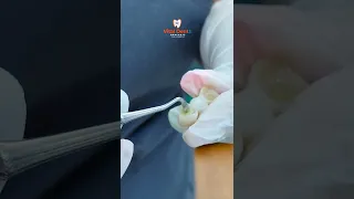 Instalación de un Puente Dental 🦷😷👌