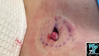 The Abscess that dressed up as a cyst for Halloween. Large deep abscess pocket on chest popped.