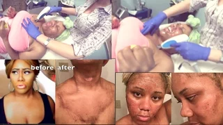 SKINCARE GONE WRONG! GRAPHIC! LIVE LASER SKIN RESURFACING!