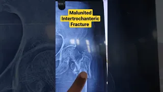 Malunited Intertrochanteric Fracture ..Dr Sai Chandra