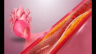 Acute Coronary Syndrome