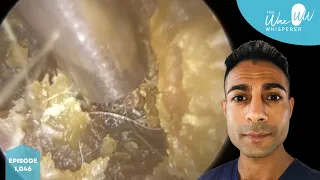 1,046 - Very Impacted Dry Ear Wax & Skin Removal