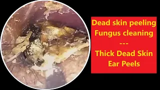 Thick Dead Skin Ear Peels 2023-12-14 #relaxing #satisfying #asmr