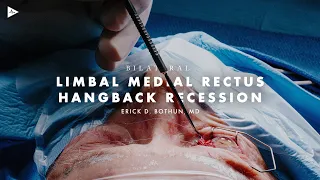 Bilateral Limbal Medial Rectus Hang-Back Recession by Erick D. Bothun, MD | Preview