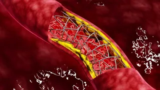 Die 3 D Animation zeigt einen platzierten Stent in einer offenen Arterie mit Blut durchfluss