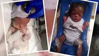 Mother can finally hold baby born without skin