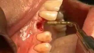 Implant Site Prep 2