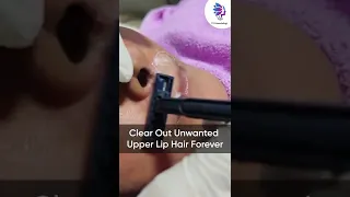 Get to Remove Upper Lip Hair by Advanced Laser Hair Removal Treatment | Vj’s cosmetology clinic