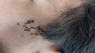 Remove thousand lice from black hair - How to remove all lice from his head