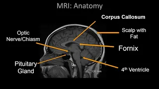 Normal Brain MRI Anatomy - Neuroradiology Made simple