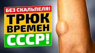 Жировик удаляется безопасно и просто! Советский способ избавления от липомы!