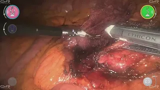 Robotic oncologic Right Colectomy with a new robotic platform (CMR Versius)
