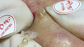 #01 Blackhead on right cheek (Cuong Part 1)