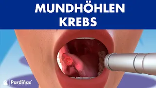 MUNDHÖHLEN KREBS - Symptome, Ursachen und Arten von mundkrebs ©