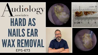 HARD AS NAILS EAR WAX REMOVAL - EP673