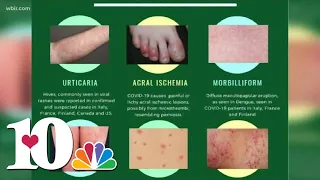 Doctor: Skin rash could be a symptom as possible COVID-19 symptom