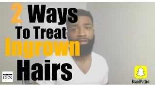 2 Ways To Treat Ingrown Hairs In 2 Minutes
