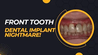 Front Tooth Dental Implant Gone Wrong. Bone Graft or Gum Graft?  How to Prevent This From Happening!