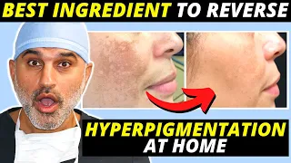 BEST At Home Solution (that works!) to Manage Hyperpigmentation and Melasma