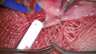 Microvascular Venous Anastomosis: Termino-Lateral Technique